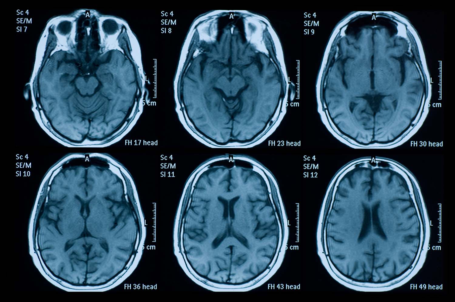 mri